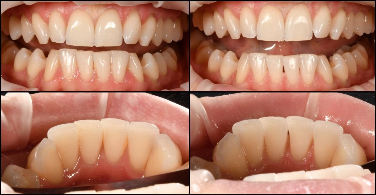 Resultados antes y después de limpieza dental (scaling) en RIKOTA Dental Clinic, mejor higiene