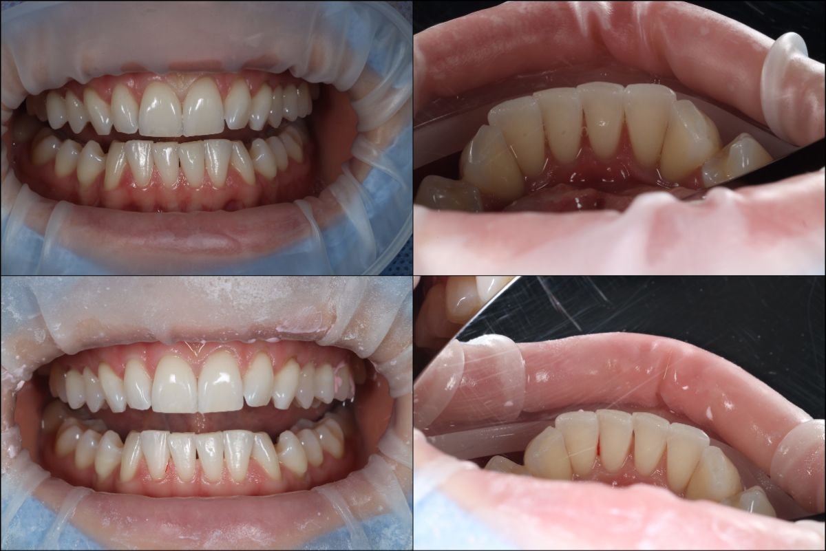 Resultados antes y después de limpieza dental (scaling) en RIKOTA Dental Clinic, mejor higiene