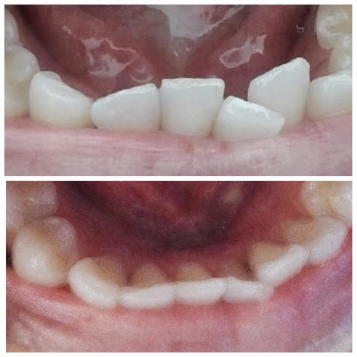 Результаты до и после брекетов в Love Dental and Sthetic Clinic, выравнивание зубов