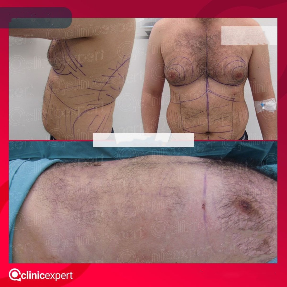 Resultados de liposucción masculina antes y después en CE International Hospital, mejor contorno torácico