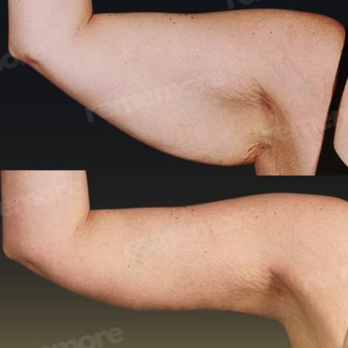 Before and after arm lift (brachioplasty) results at Memorial Göztepe Hospital, tighter arms