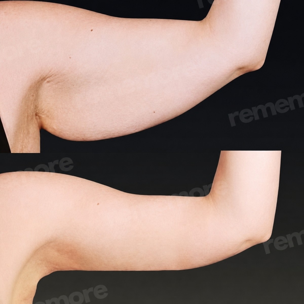 Before and after arm lift (brachioplasty) results at Memorial Göztepe Hospital, improved contour