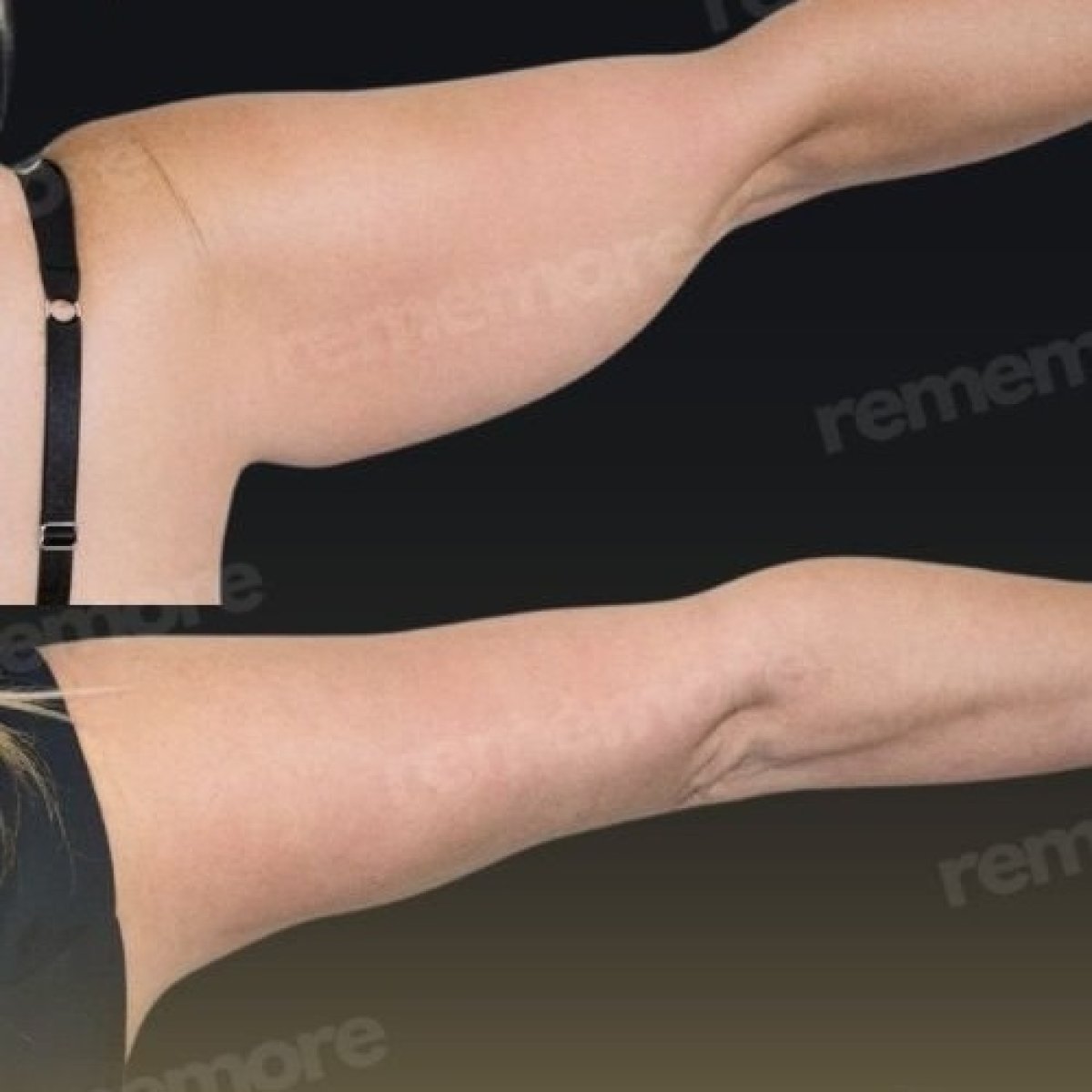 Resultados de lifting de brazos antes y después en Memorial Göztepe Hospital, mejor contorno