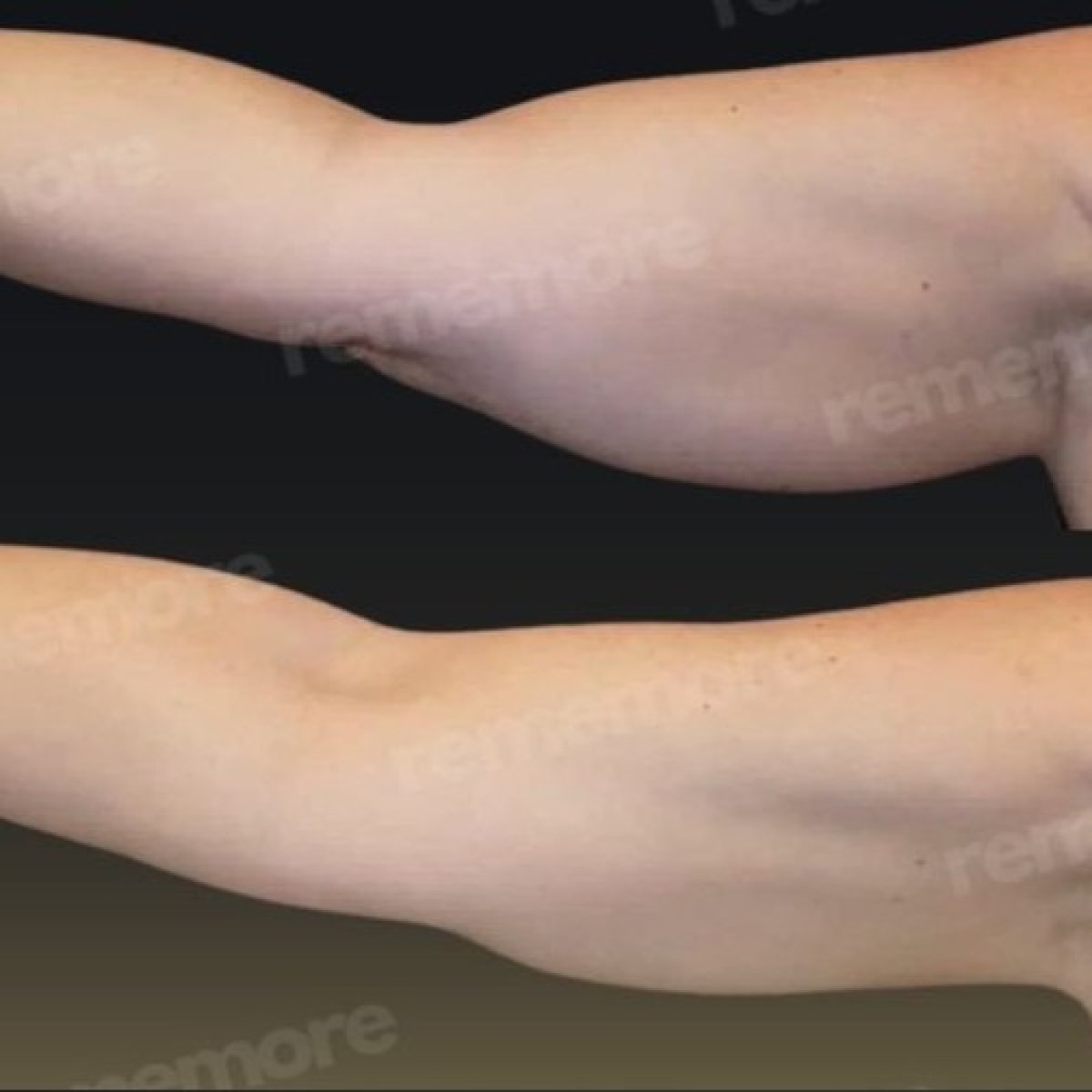 Before and after arm lift results at Memorial Göztepe Hospital, improved arm contour