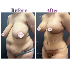 Breast Reduction by European Board Certified Surgeon — All Included - photo 5