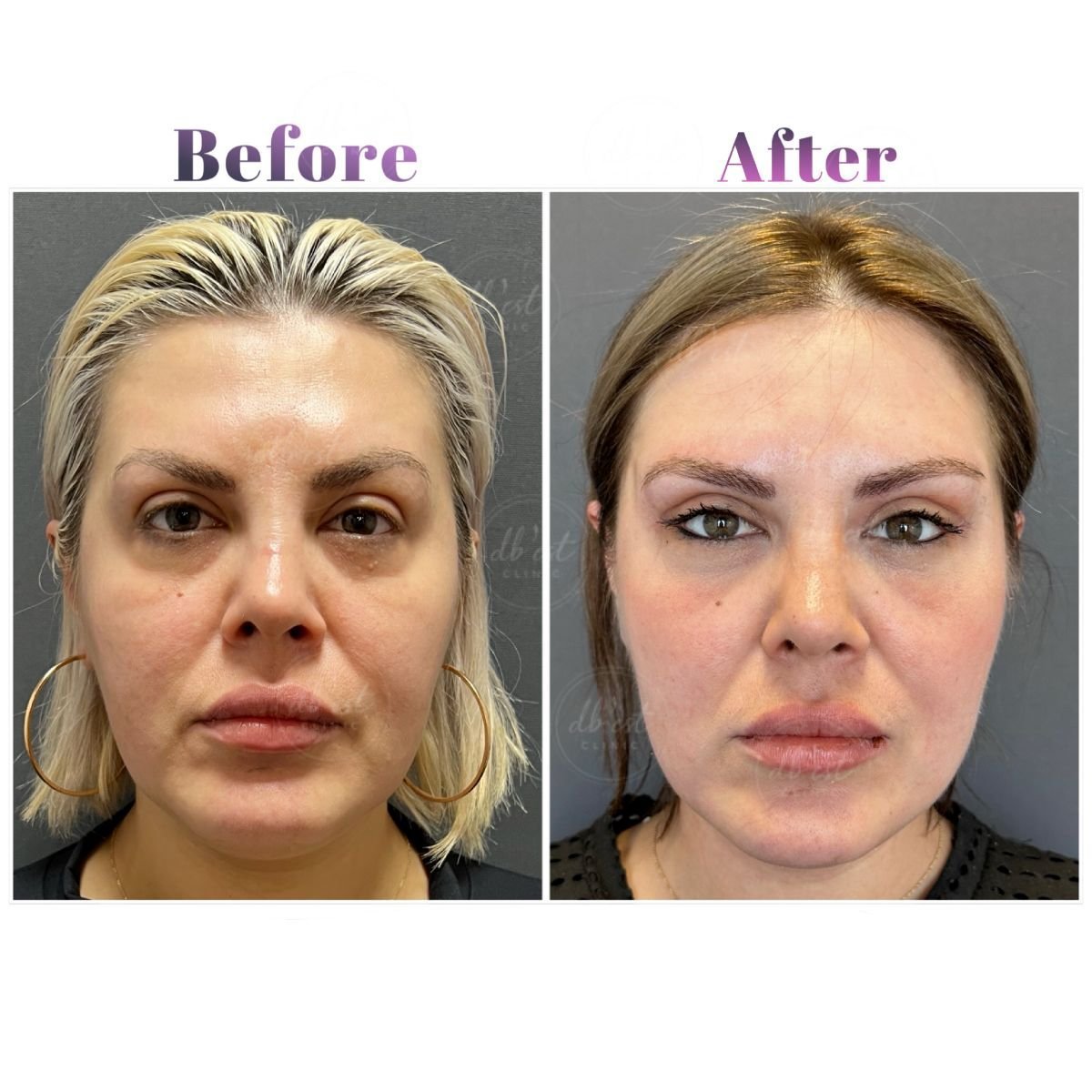 Résultats avant et après blépharoplastie à Db'est Clinic – correction des paupières