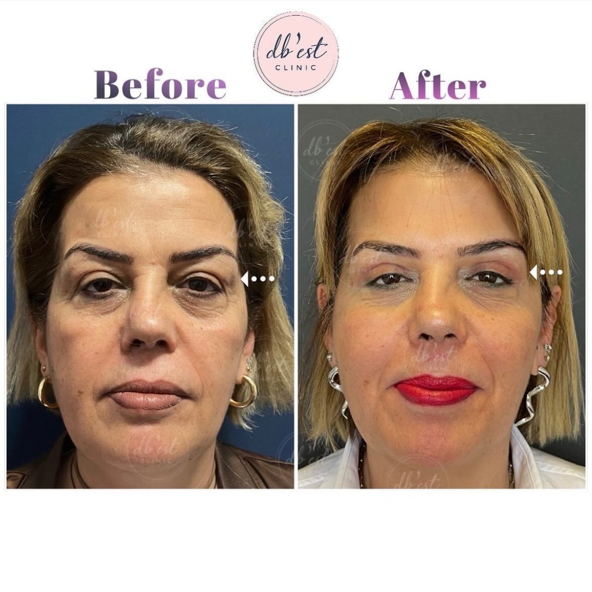 Resultados de blefaroplastia antes y después en Db'est Clinic – corrección de párpados