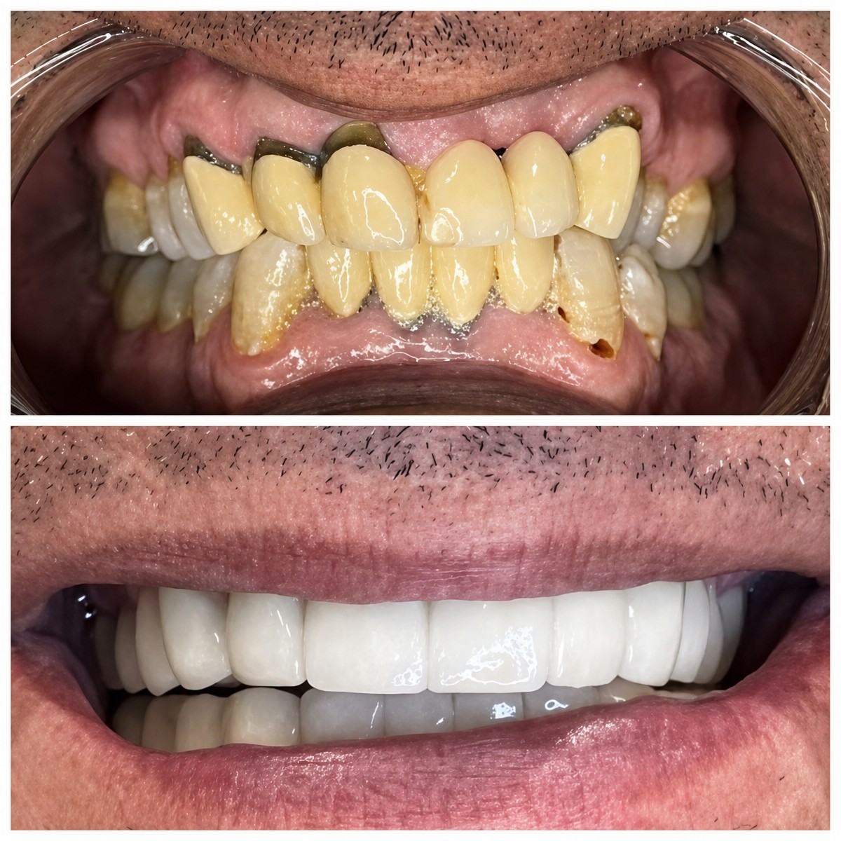 Результат до и после имплантации All-on-4 в Dental Bosphorus, восстановление улыбки