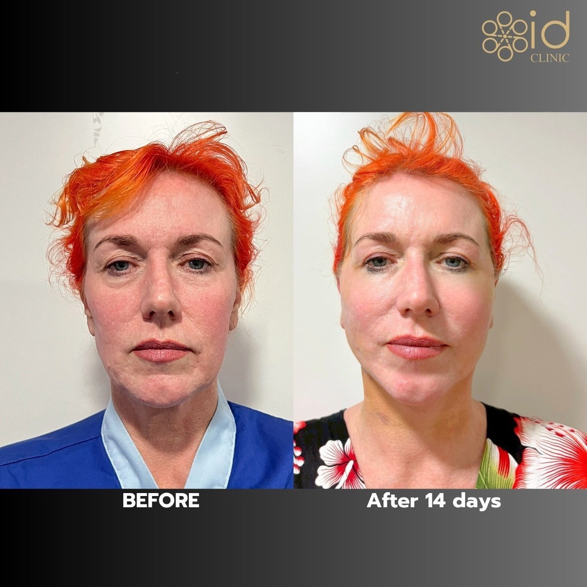 Upper and lower eyelid surgery before and after results at ID Clinic Bangkok, 14 days post-op