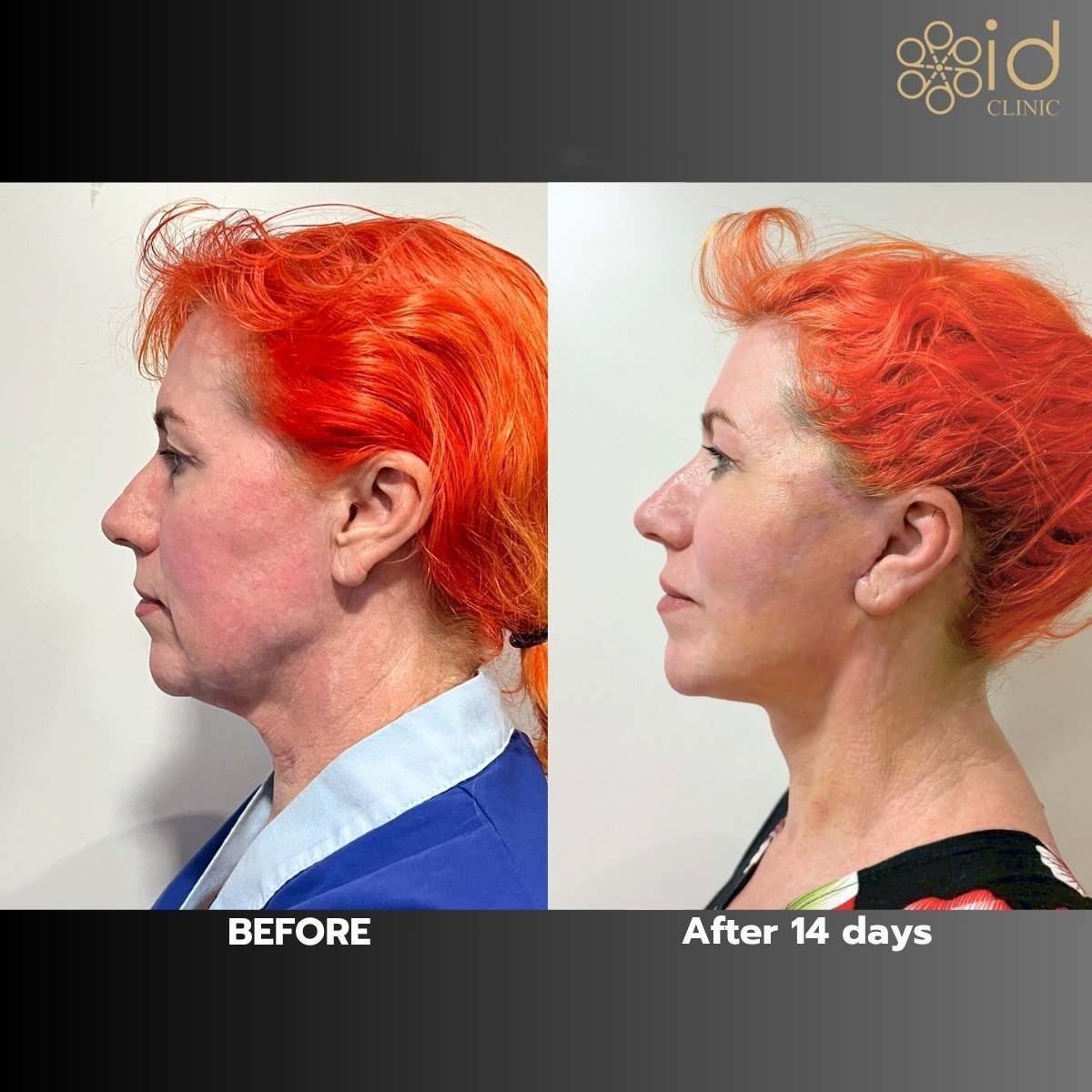 Before and after facelift results at ID Clinic Bangkok, visible facial rejuvenation after 14 days