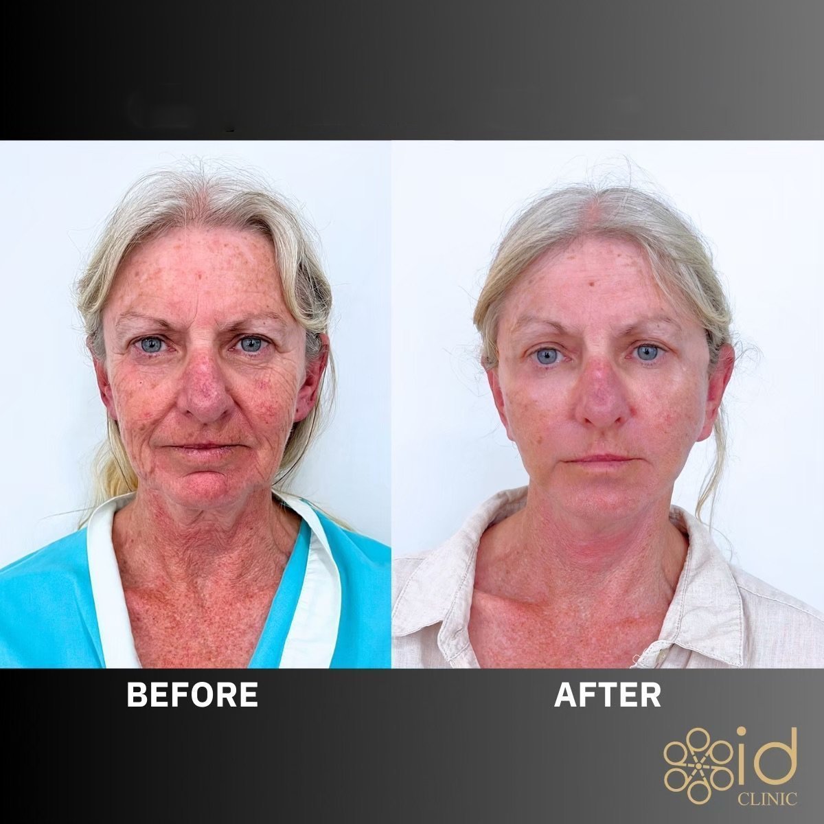 Before and after upper and lower eyelid surgery results at ID Clinic Bangkok, rejuvenated look