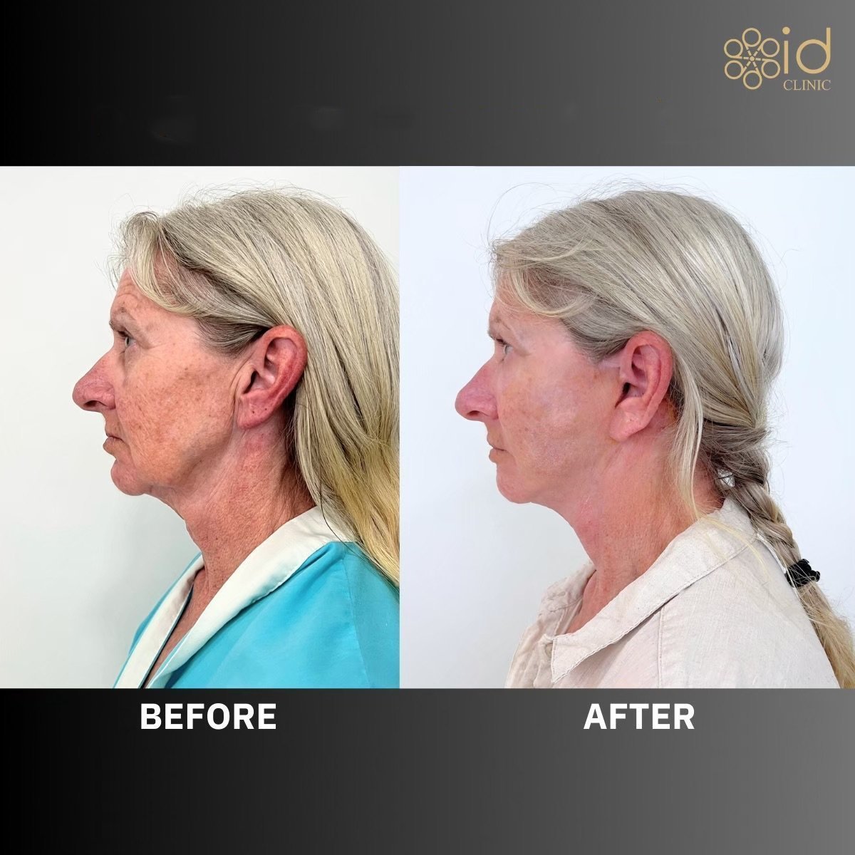 Before and after upper and lower eyelid surgery results at ID Clinic Bangkok, rejuvenated look