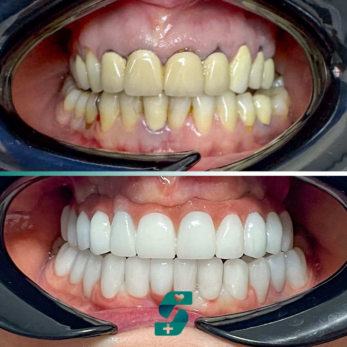 Before and after All-on-6 dental implants result at Soraca Med – full smile restoration