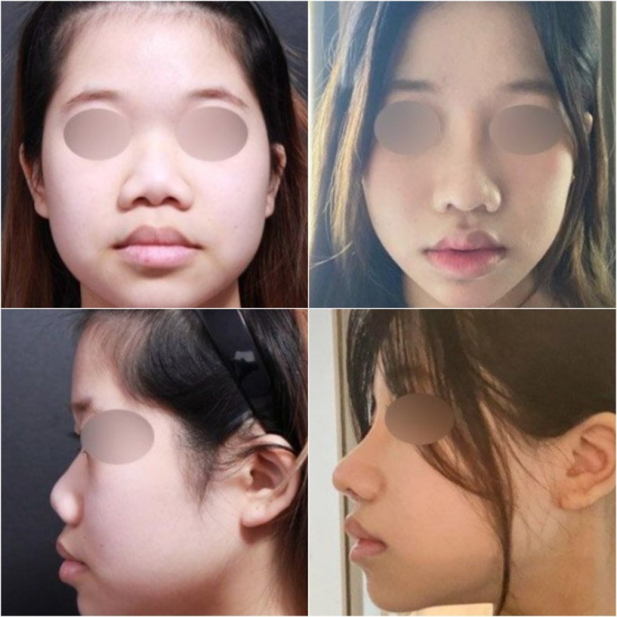نتائج قبل وبعد عملية تصغير فتحات الأنف في VG Plastic Surgery، تحسين شكل الأنف