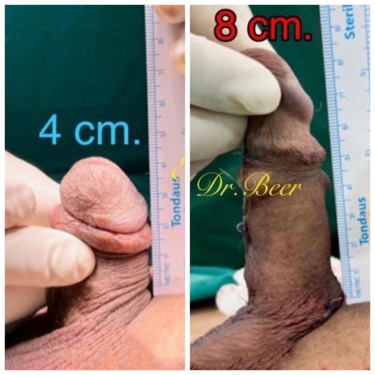 نتائج قبل وبعد تطويل القضيب الجراحي في Eternity Clinic Pleonchit، زيادة الطول