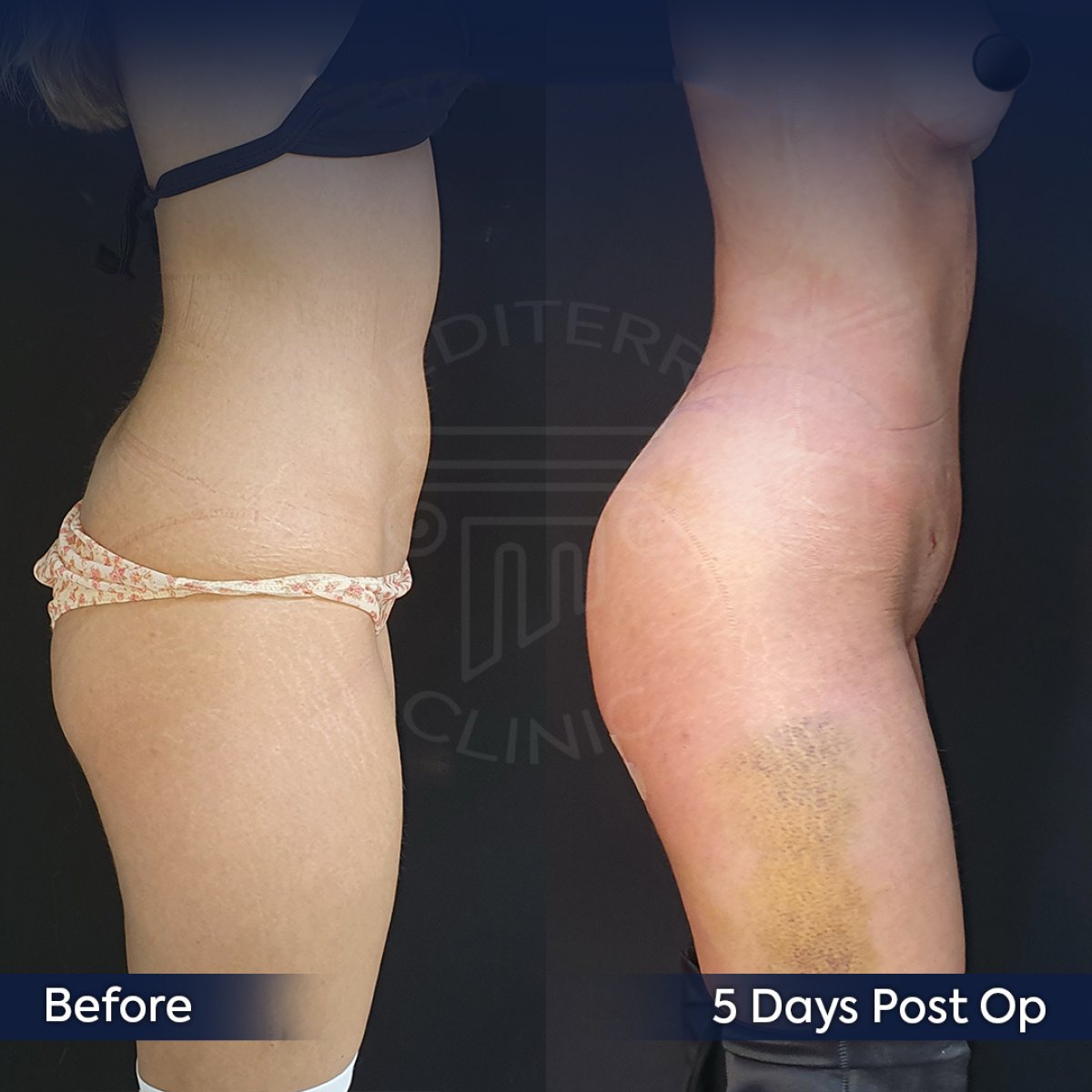 Résultats avant/après Brazilian Butt Lift à la clinique Dr. Safa Manav, courbes améliorées