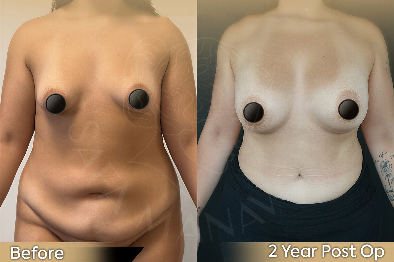 Resultados de abdominoplastia y liposucción antes y después en Dr. Safa Manav Clinic, contorno corporal