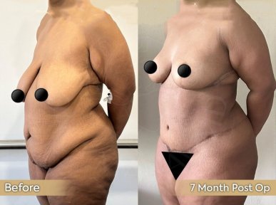 Premium Tummy Tuck and BBL with 360 vaser Liposuction + Breast lifting with Mentor implants ® All Included package - photo 4