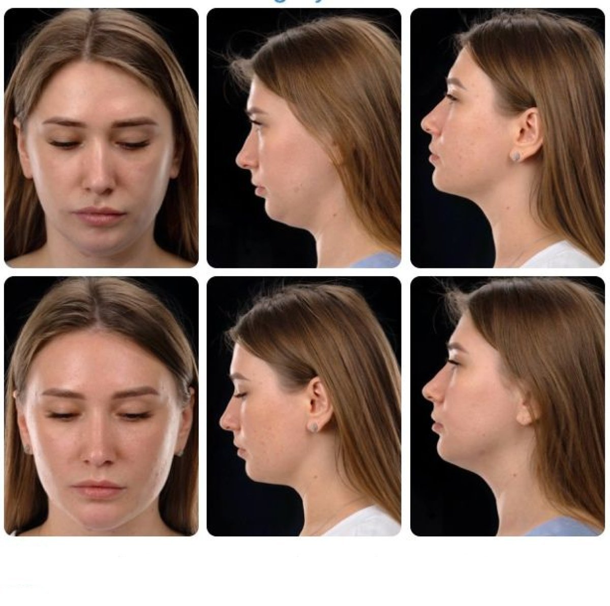 نتائج شفط دهون الذقن قبل وبعد في Yurchenko Plastic Surgery Team، تحسين خط الفك