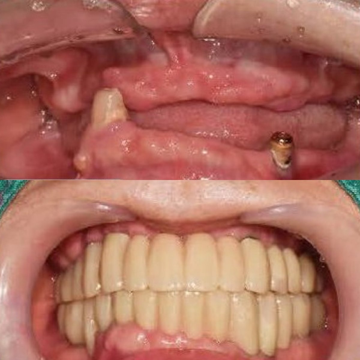 Resultados de implantes dentales antes y después en 365SeoulOneTop365 Dental Clinic, restauración total