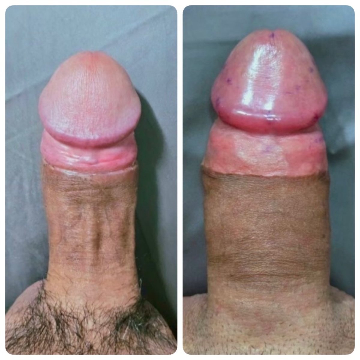 نتائج قبل وبعد حقن الفيلر للعضو الذكري في Eternity Clinic Phuket By Dr.Beer، تحسين واضح