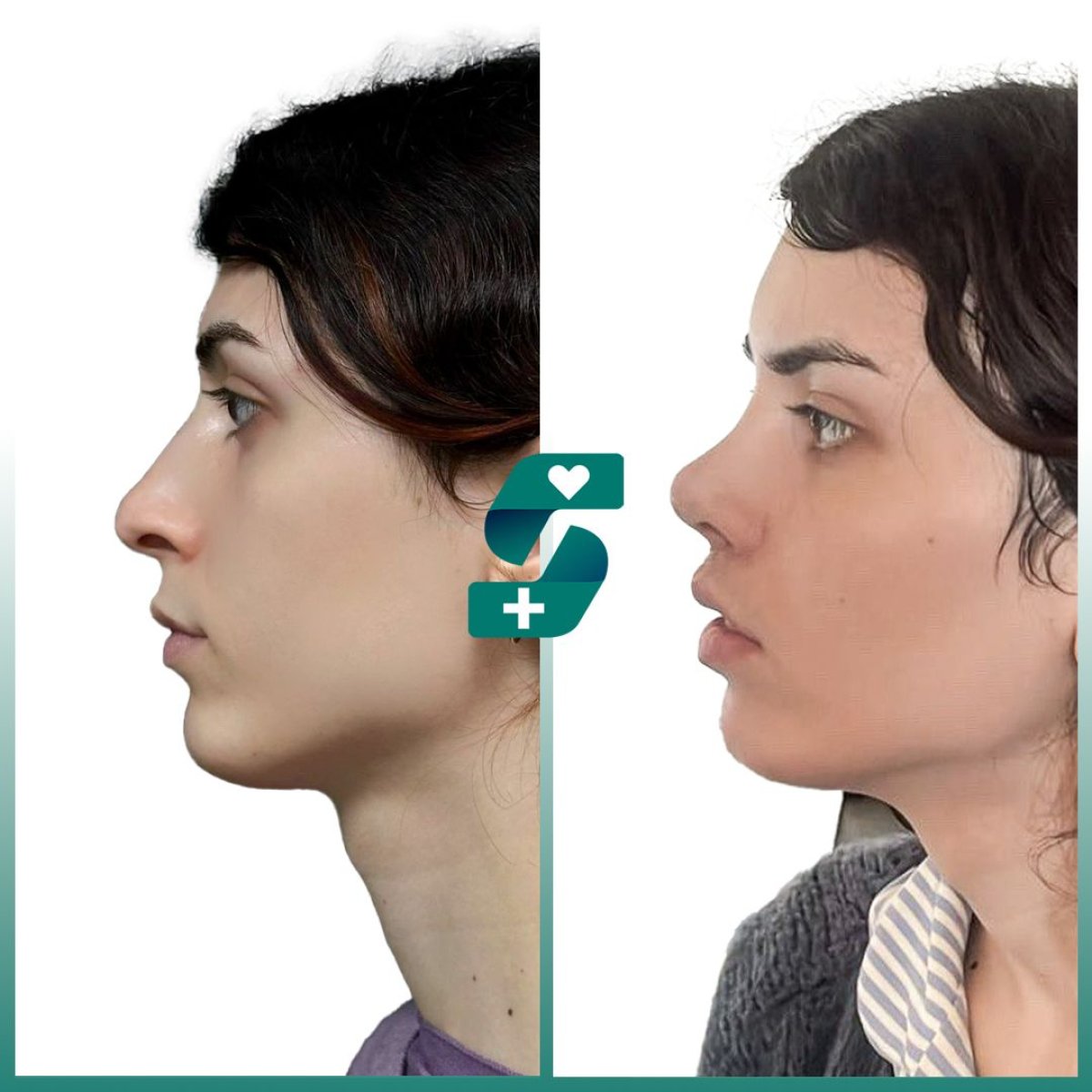 Before and after rhinoplasty result at Soraca Med, improved nose shape and profile