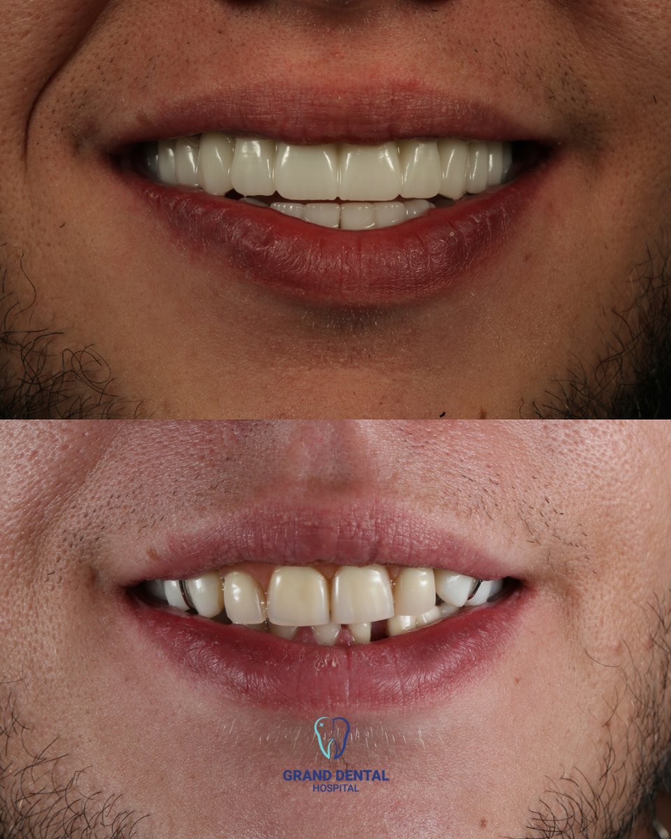 Результаты до и после установки циркониевых коронок в Grand Dental Hospital & Laboratory