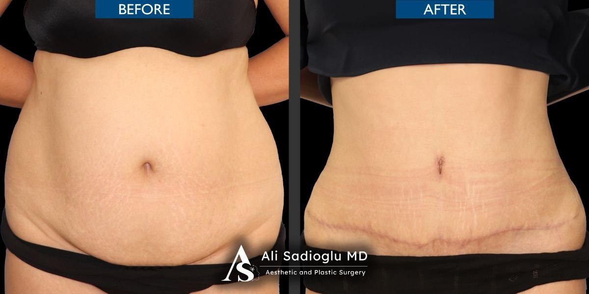 Before and after tummy tuck and liposuction results at Dr. Safa Manav Clinic, flatter abdomen