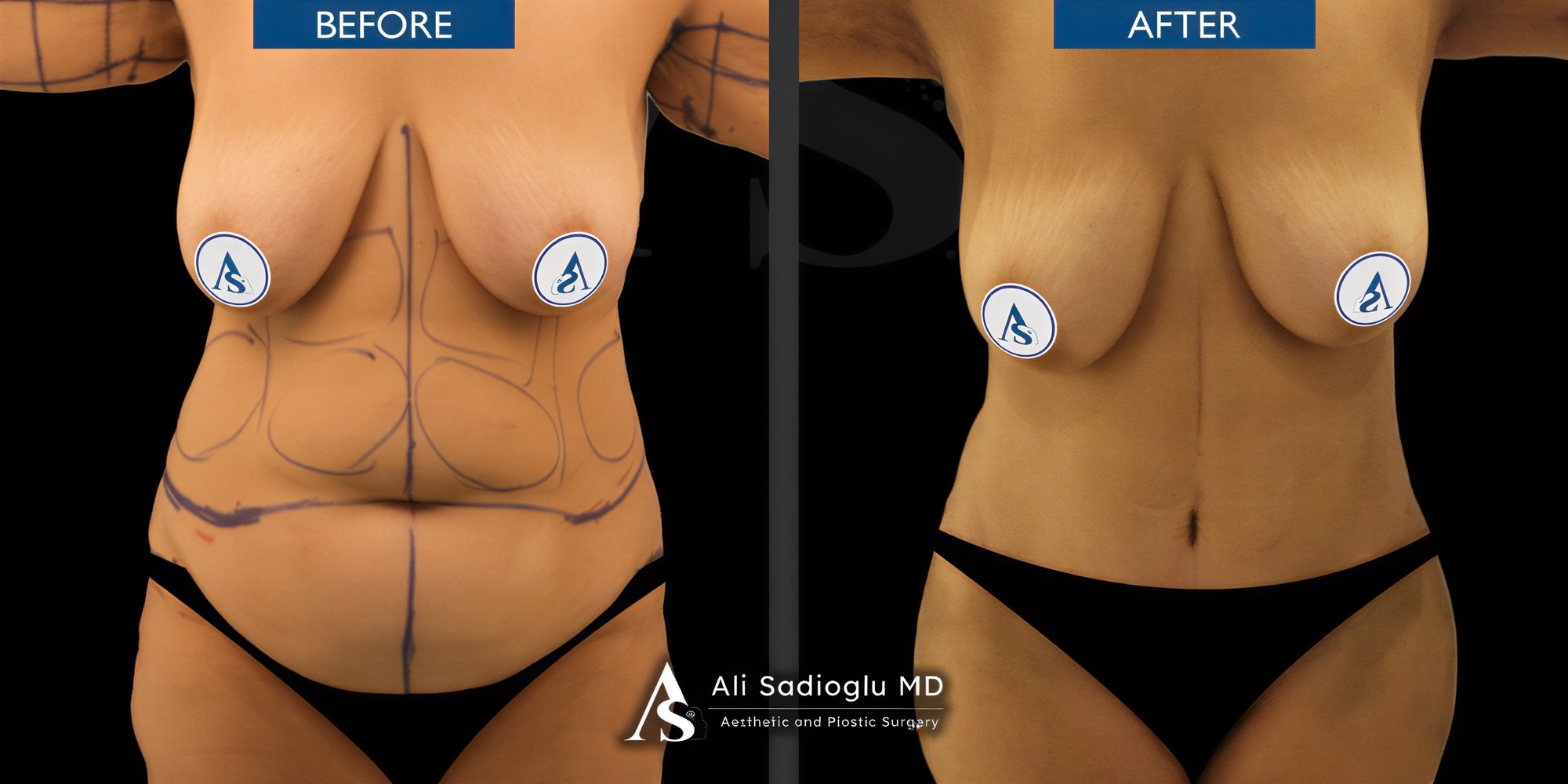 Resultados de abdominoplastia y liposucción antes y después en Dr. Safa Manav Clinic, cintura más delgada