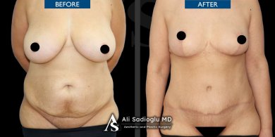 Premium Tummy Tuck and BBL with 360 vaser Liposuction + Breast lifting with Mentor implants ® All Included package - photo 6