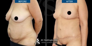 Mommy makeover surgery -Tummy tuck with 360 vaser liposuction with breast lifting with implants. - photo 6