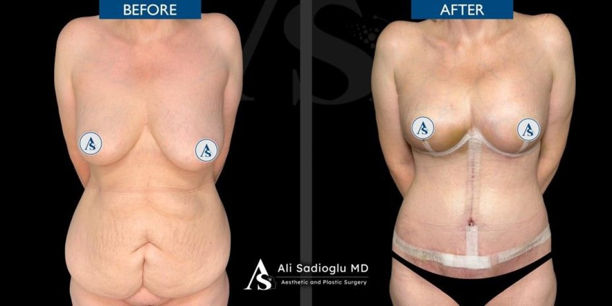 Before and after tummy tuck and liposuction results at Dr. Safa Manav Clinic, body contouring