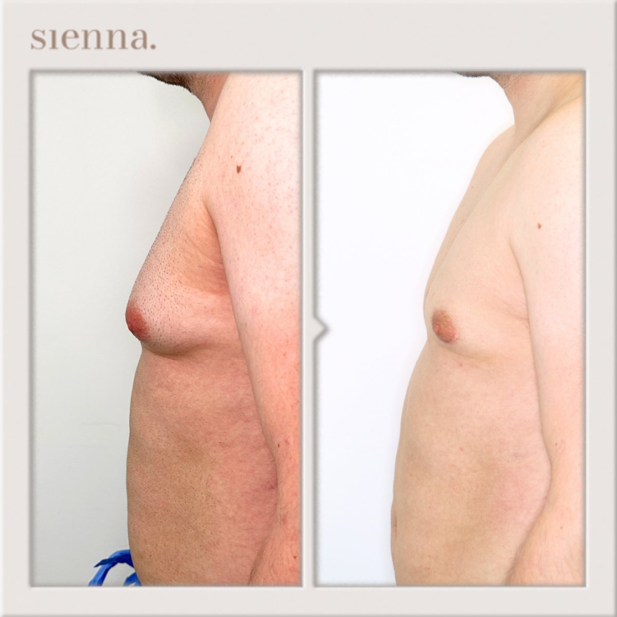 Résultats avant/après chirurgie gynécomastie à Sienna Clinic – amélioration du torse masculin