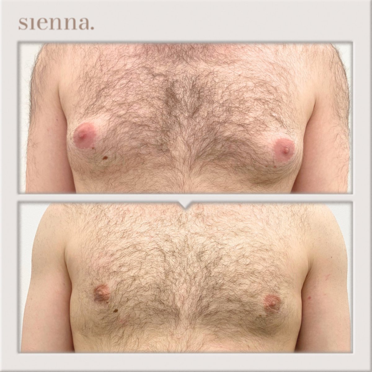 Résultats avant et après chirurgie gynécomastie à Sienna Clinic, contour du torse amélioré