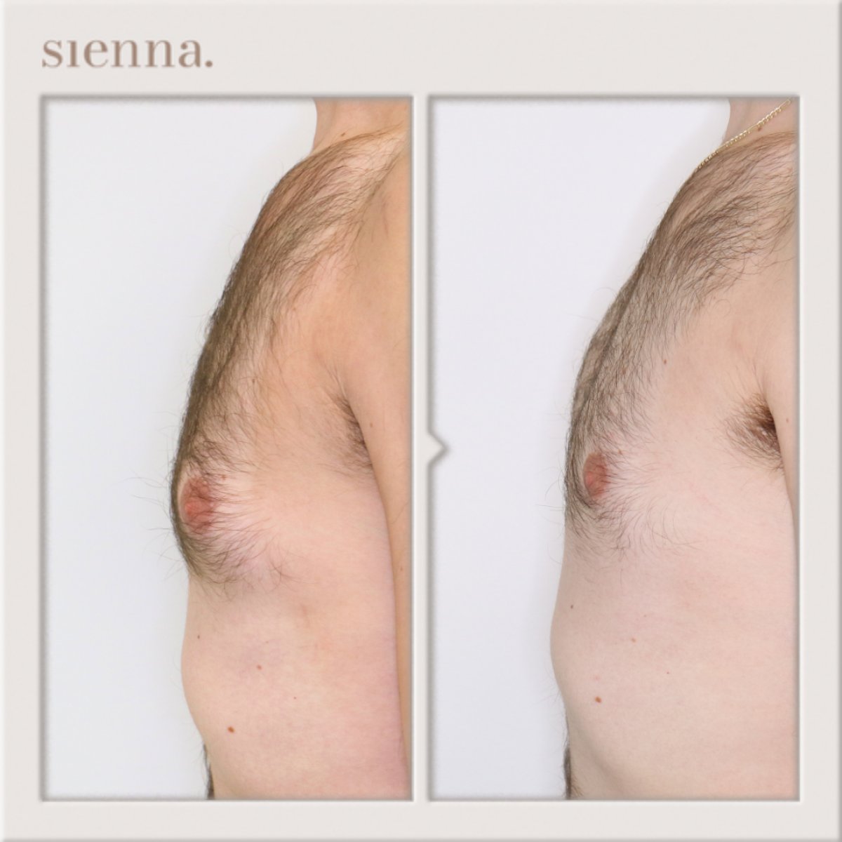 Результаты до и после операции гинекомастии в Sienna Clinic – улучшение контура груди