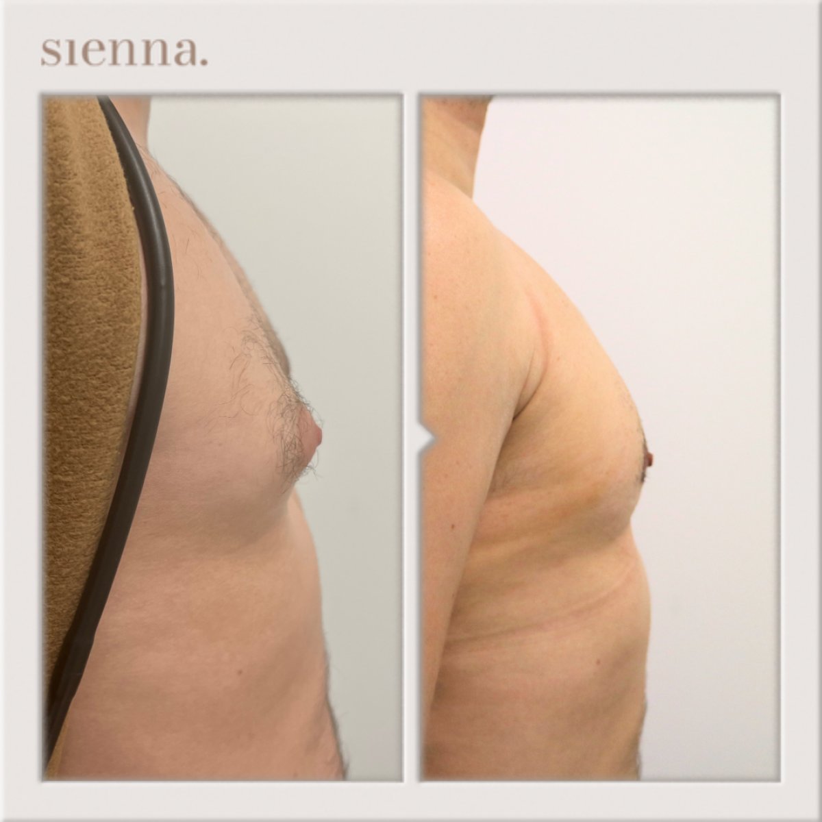 Before and after gynecomastia surgery results at Sienna Clinic, male chest contour improved