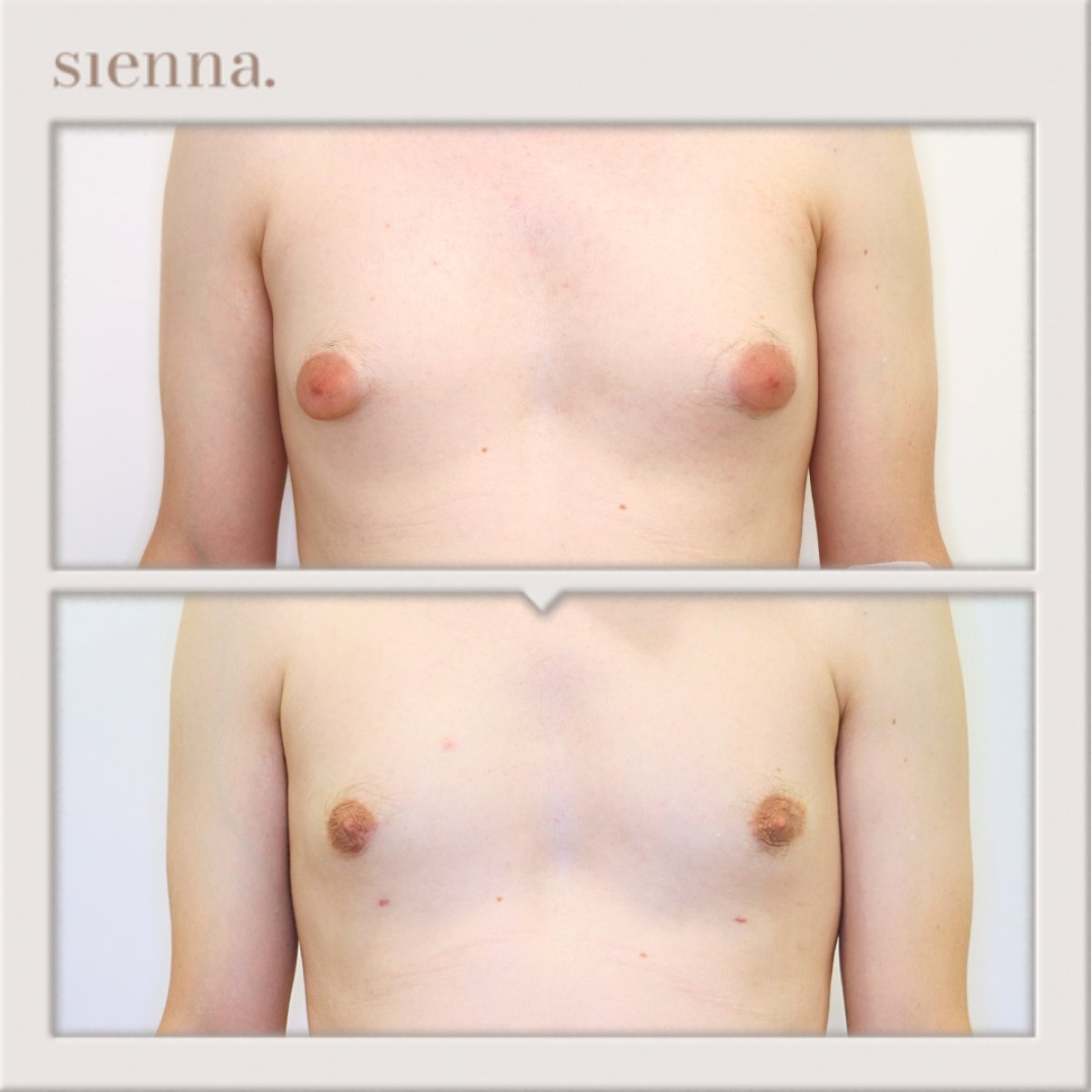 Résultats avant/après chirurgie gynécomastie à Sienna Clinic – amélioration du torse