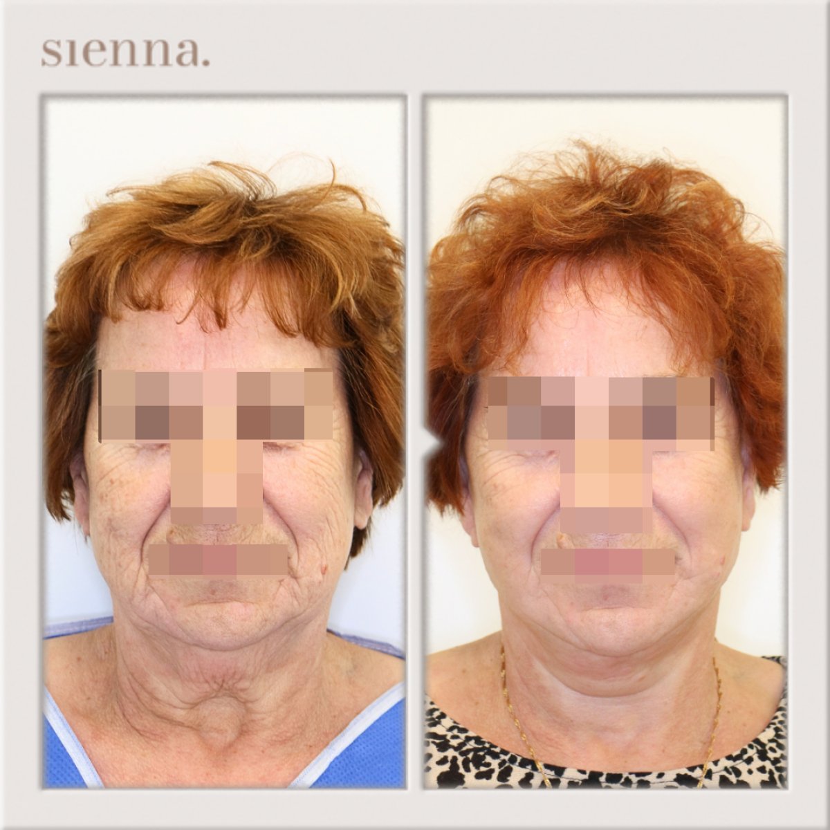 نتائج شد الرقبة قبل وبعد في Sienna Clinic، شد وتجديد واضح للبشرة
