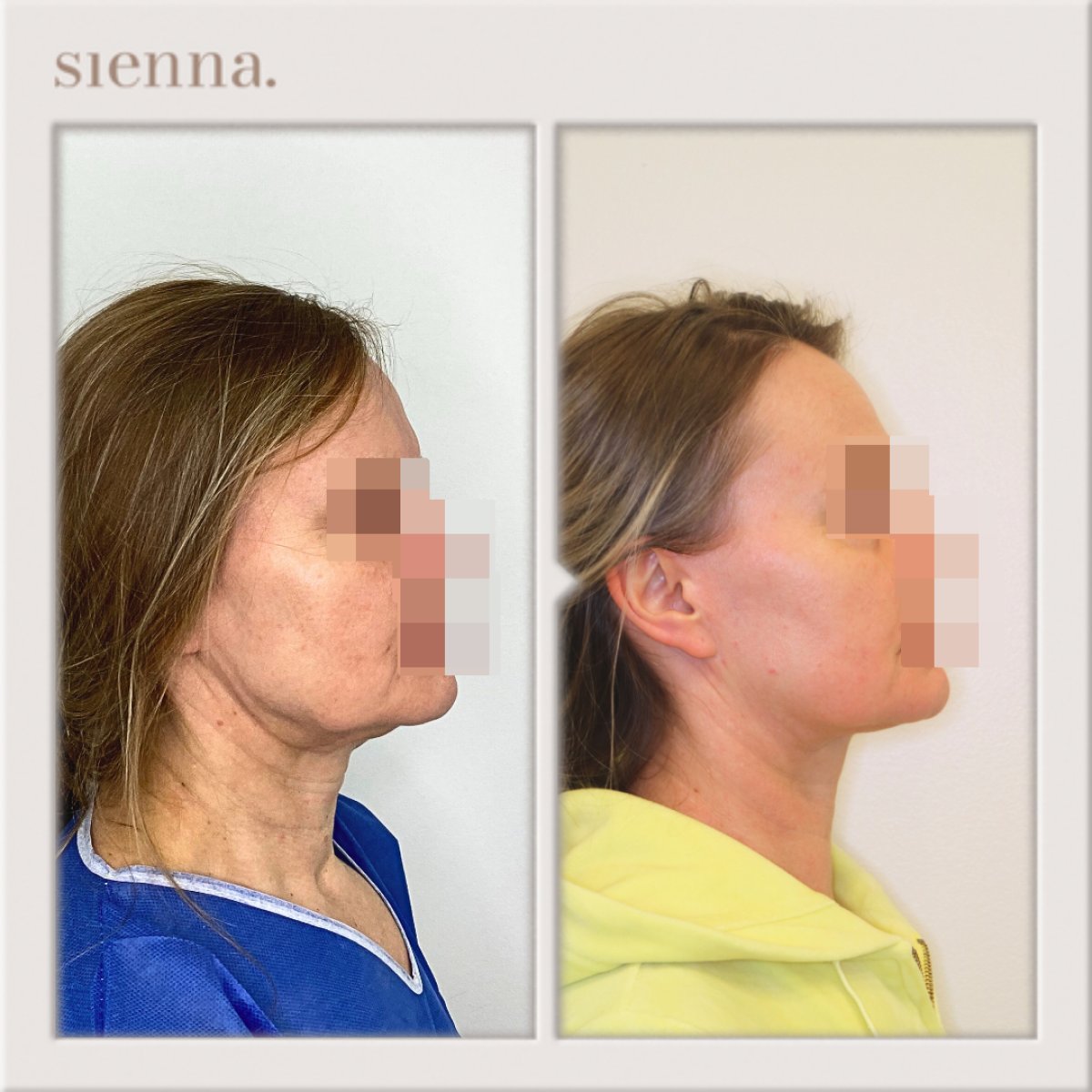 Résultats lifting du cou avant/après à Sienna Clinic – contour du cou amélioré