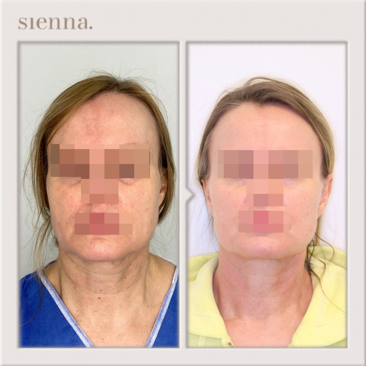 نتائج شد الوجه قبل وبعد في Sienna Clinic، تجديد ورفع واضح للوجه
