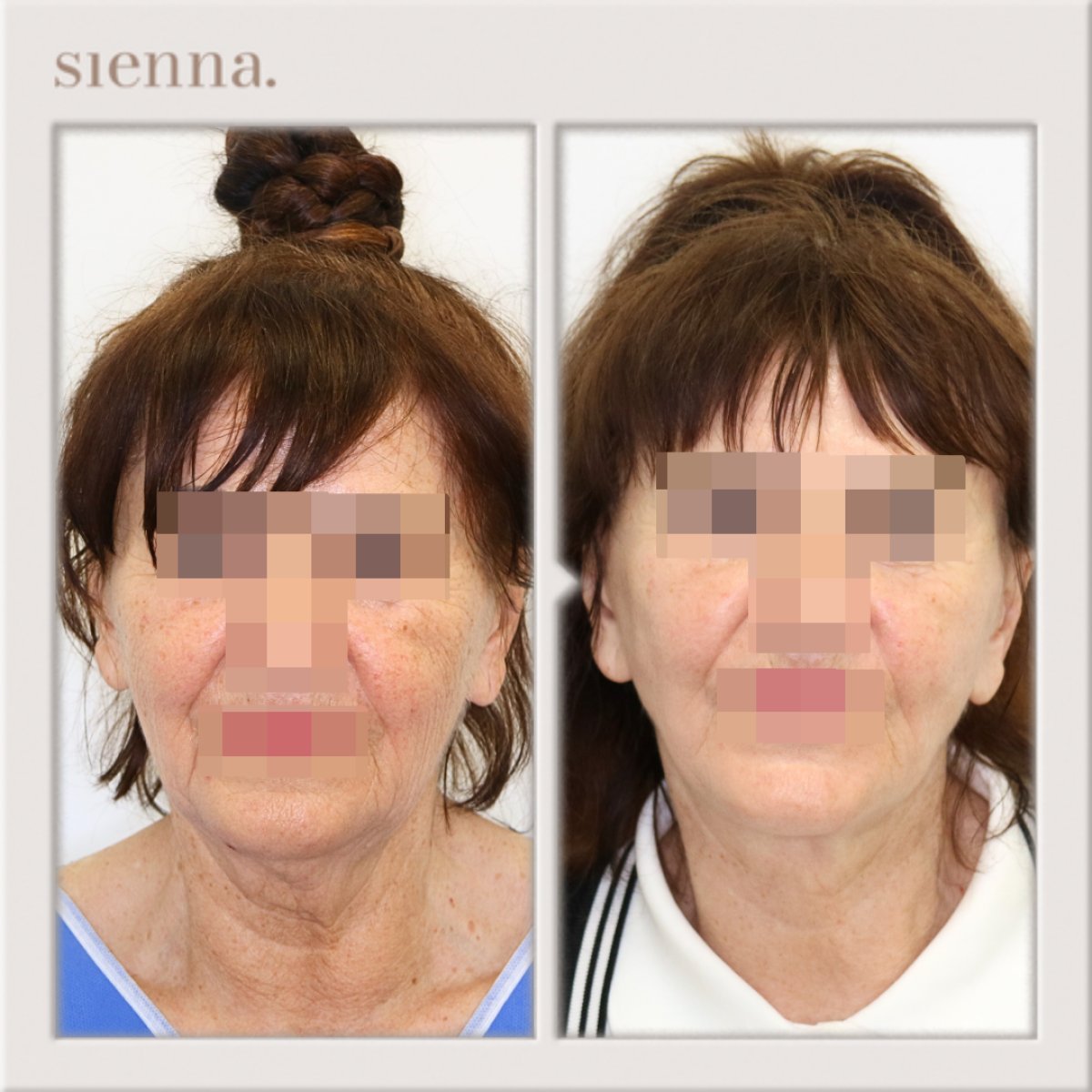 نتائج شد الوجه قبل وبعد في Sienna Clinic، تجديد وشد ملحوظ للوجه