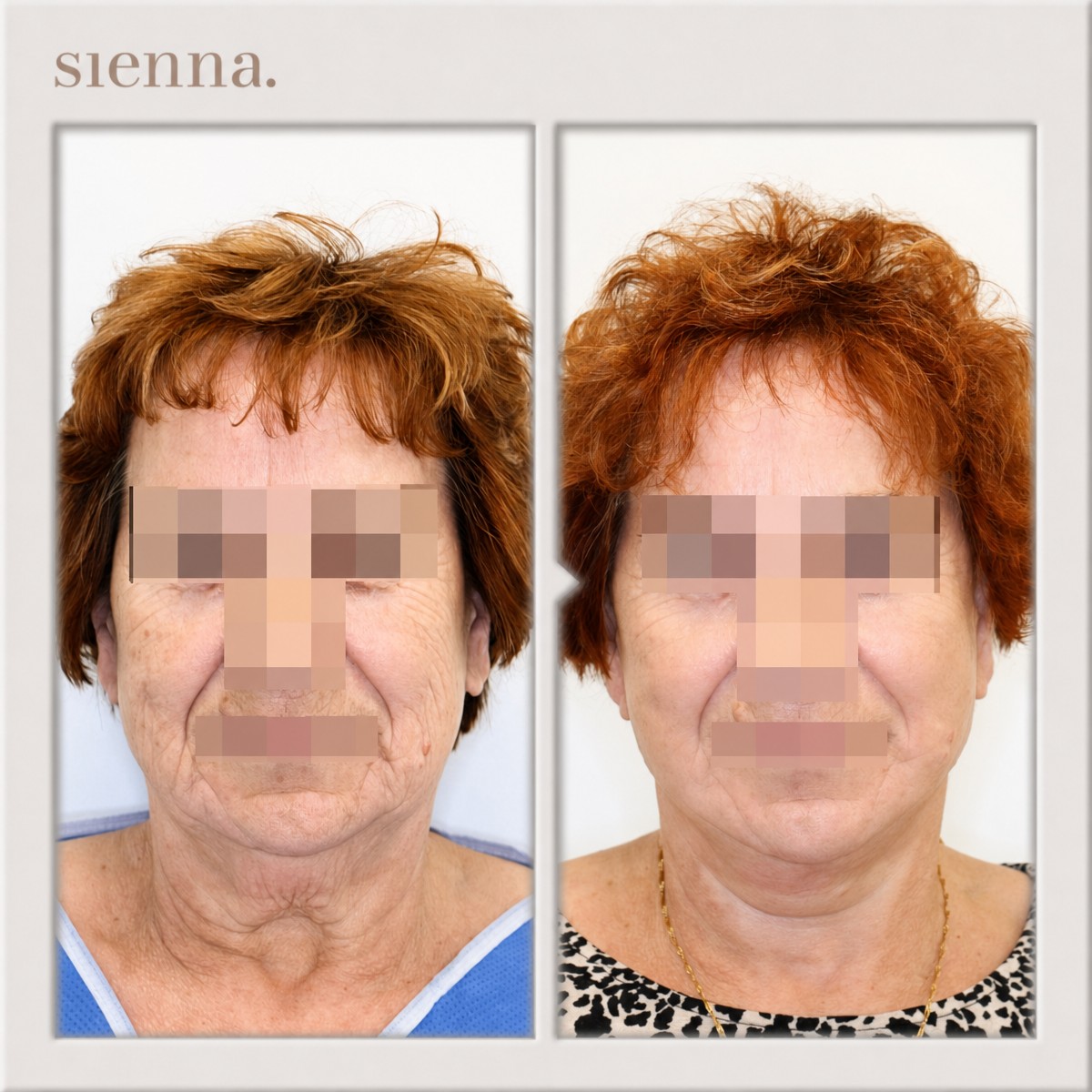نتائج شد الوجه قبل وبعد في Sienna Clinic، تجديد وشد البشرة بشكل واضح
