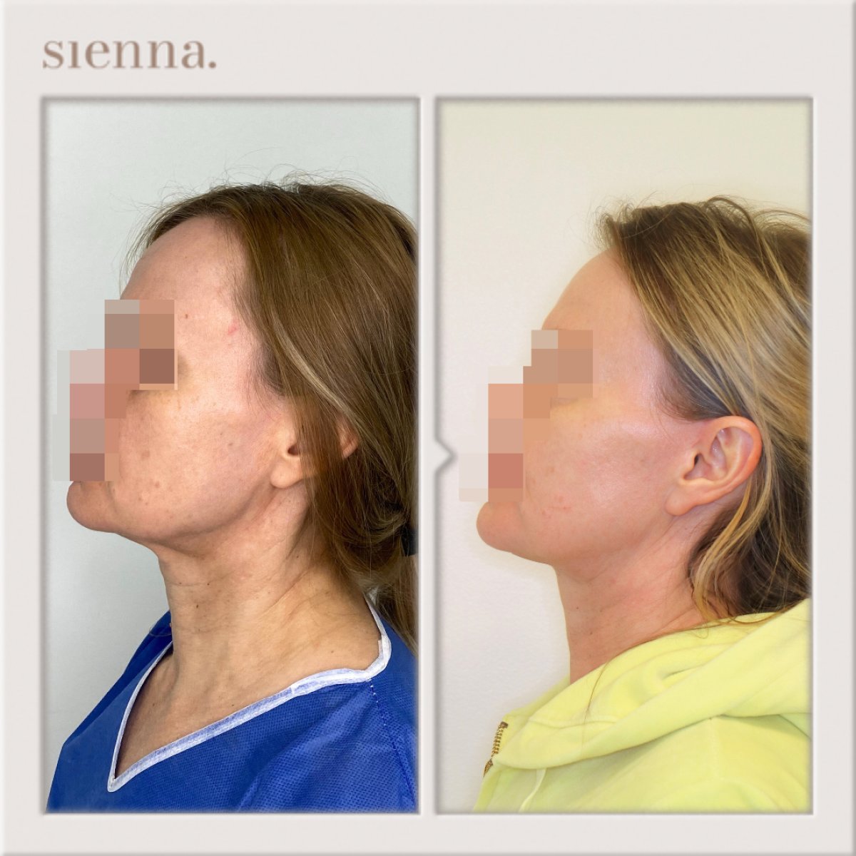 نتائج شد الوجه قبل وبعد في Sienna Clinic – تحسين واضح للفك والرقبة