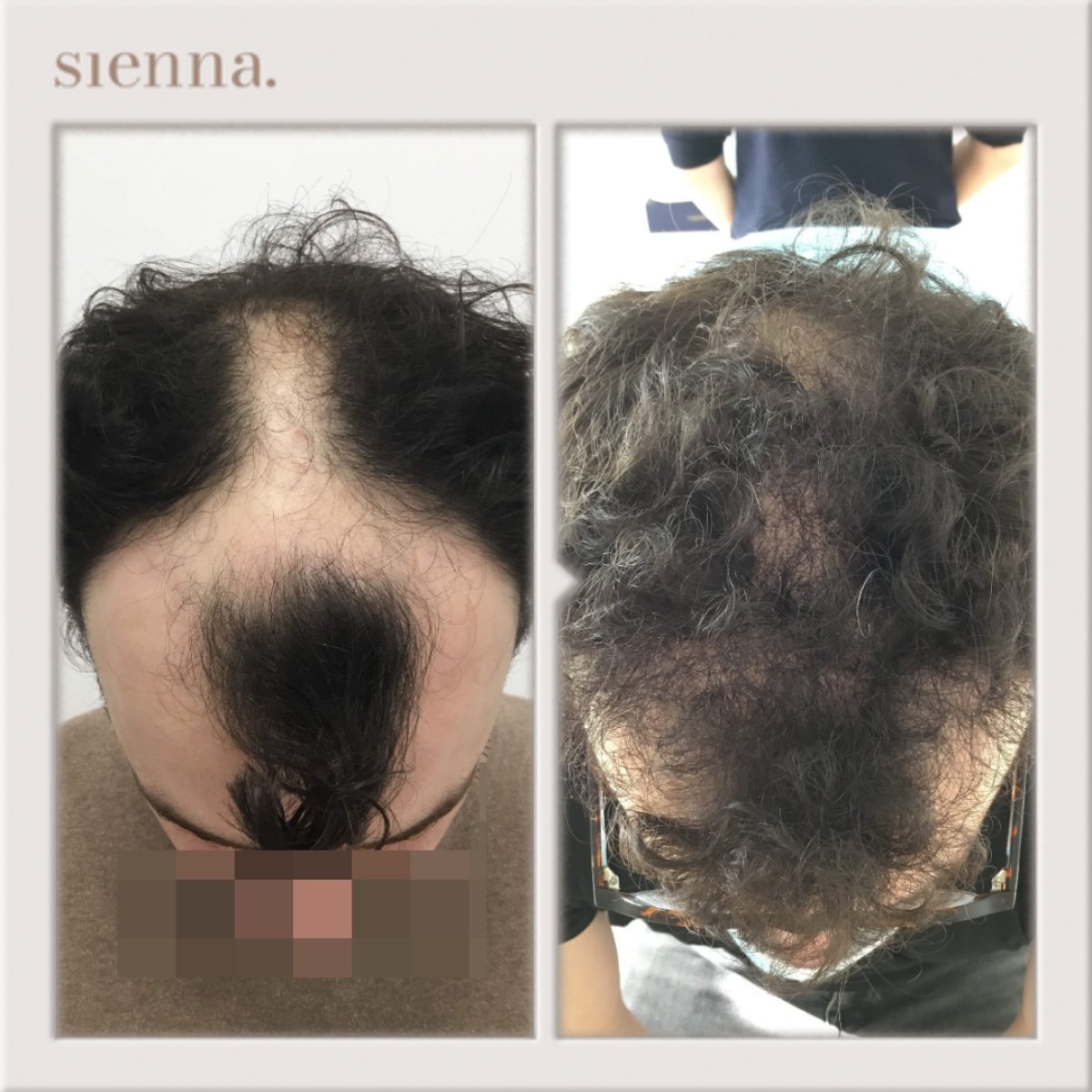 نتائج زراعة الشعر قبل وبعد في Sienna Clinic، كثافة شعر محسنة لدى المريض