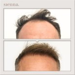 Hair transplant results by Dr. Antoni Krajewski - Patient’s before and after images Before and after Hair transplant photos by Dr. Antoni Krajewski