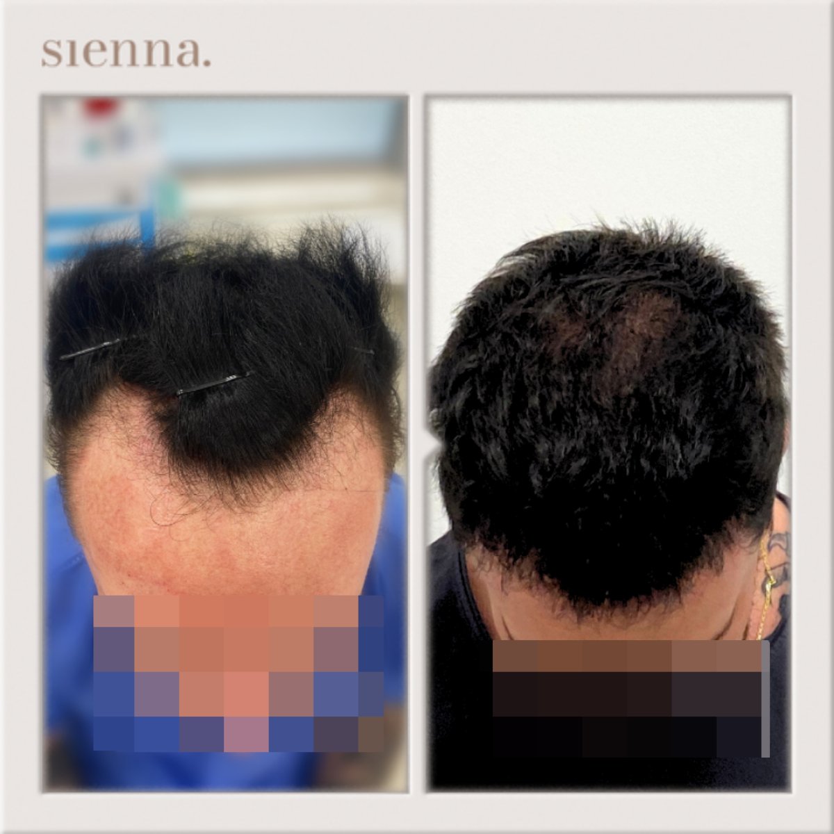 نتائج زراعة الشعر قبل وبعد في عيادة سيينا مع كثافة شعر محسنة