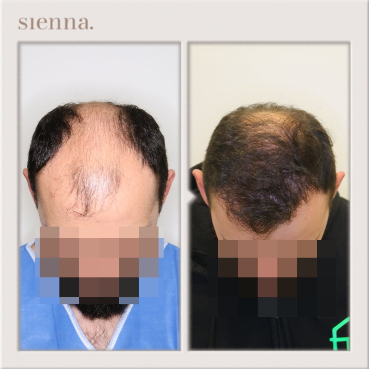 Before and after hair transplant at Sienna Clinic – restored hairline and fuller scalp result