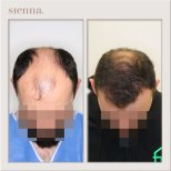 Hair transplant results by Dr. Antoni Krajewski - Patient’s before and after images Before and after Hair transplant photos by Dr. Antoni Krajewski