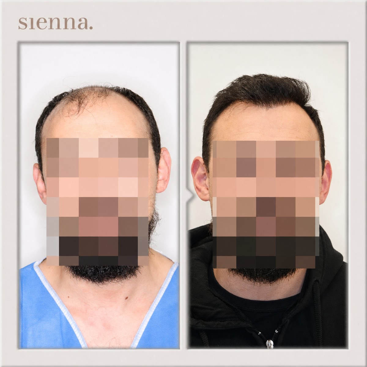 نتائج زراعة الشعر قبل وبعد في Sienna Clinic، خط شعر مستعاد وشعر أكثر كثافة