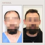 Hair transplant results by Dr. Antoni Krajewski - Patient’s before and after images Before and after Hair transplant photos by Dr. Antoni Krajewski